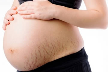 a los cuántos meses de embarazo salen estrías